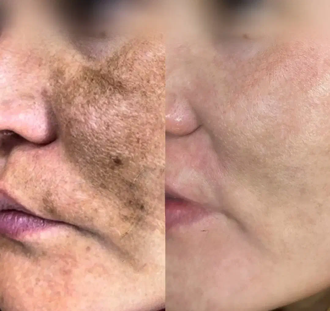 درمان تخصصی لک و کک و مک|خدمات آرایشگری و زیبایی|ساری, |دیوار