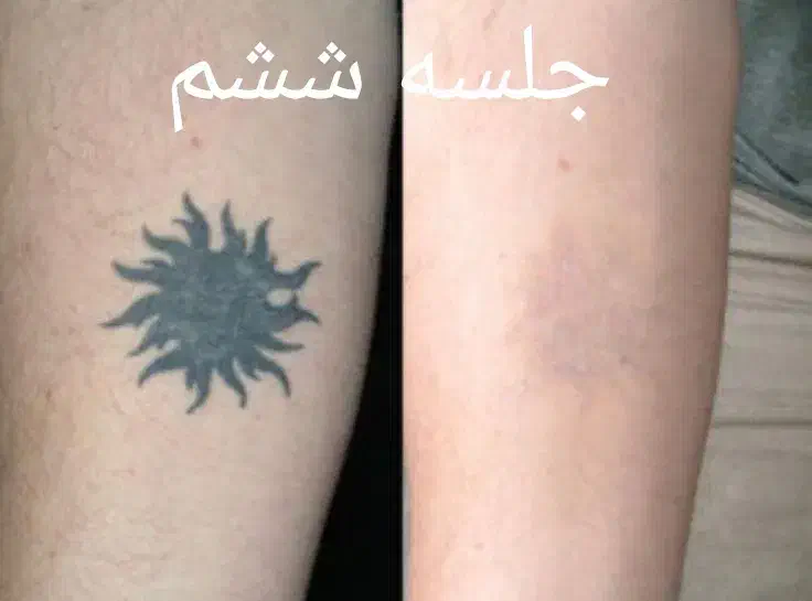 لیزر پاک کردن تتو بشکل مدرن|خدمات آرایشگری و زیبایی|اهواز, فرهنگ شهر|دیوار