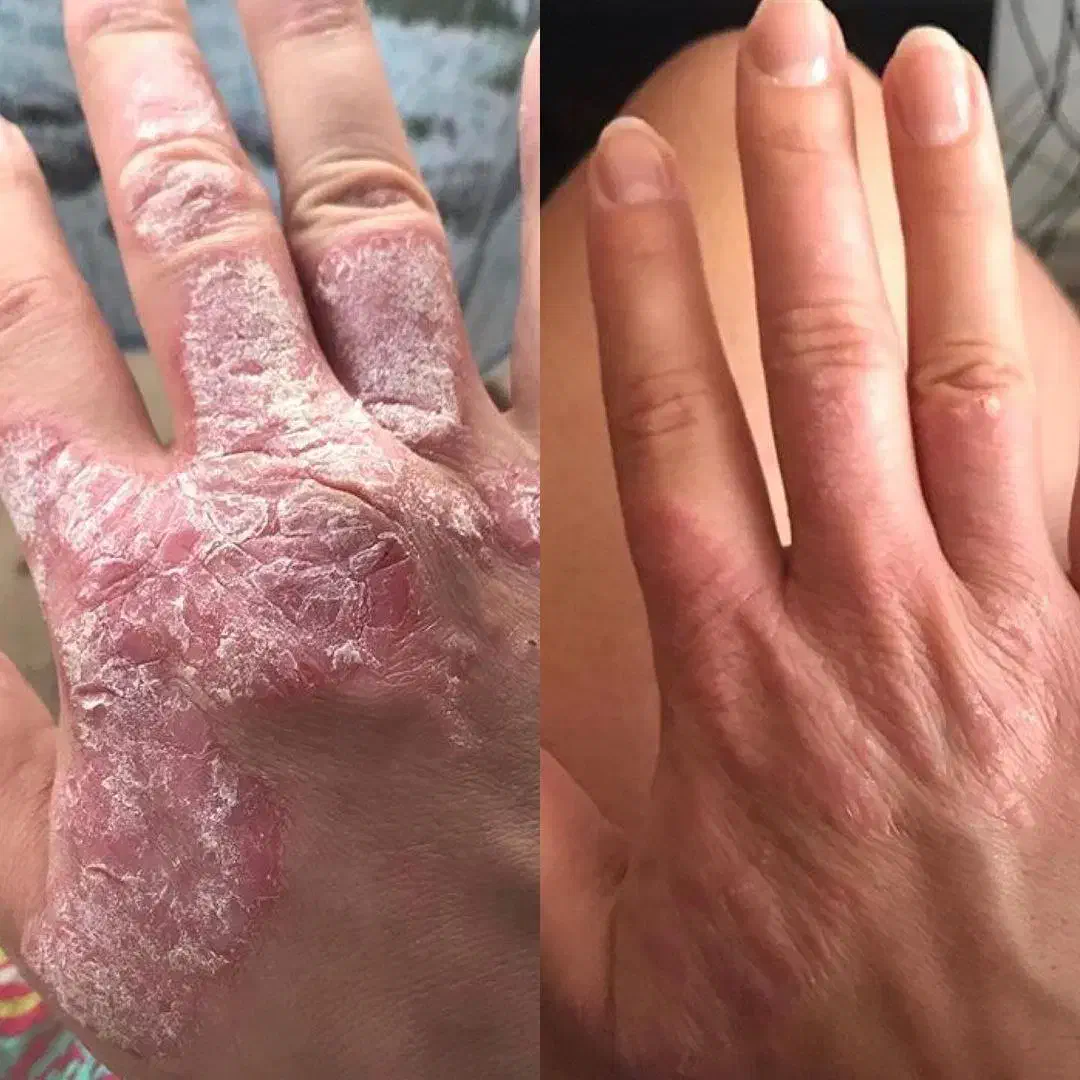 درمان پیسی و پسوریازیس|خدمات آرایشگری و زیبایی|کارون, |دیوار