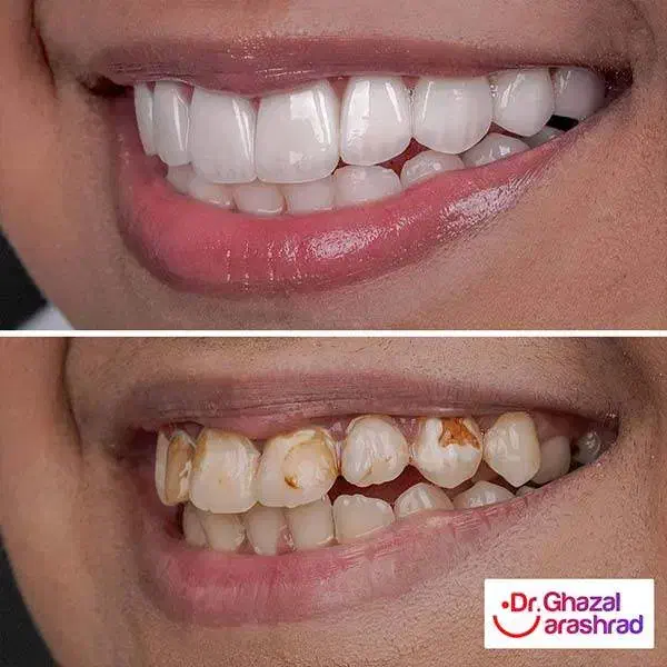 مدل برای ونیر کامپوزیت و لمینیت|خدمات آرایشگری و زیبایی|آباده, |دیوار