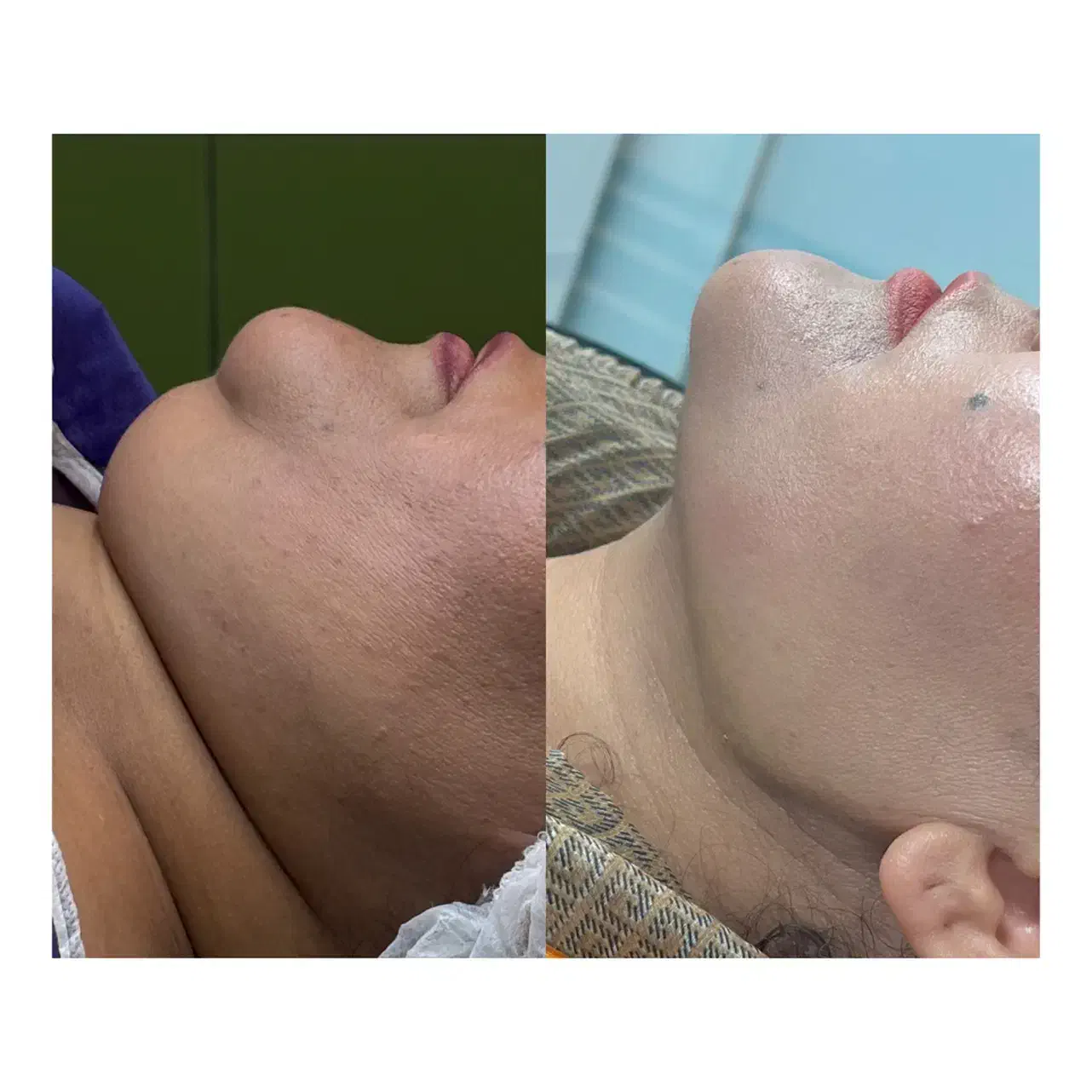 ساکشن غبغب،جراحی بلفاروپلاستی|خدمات آرایشگری و زیبایی|شهرکرد, |دیوار