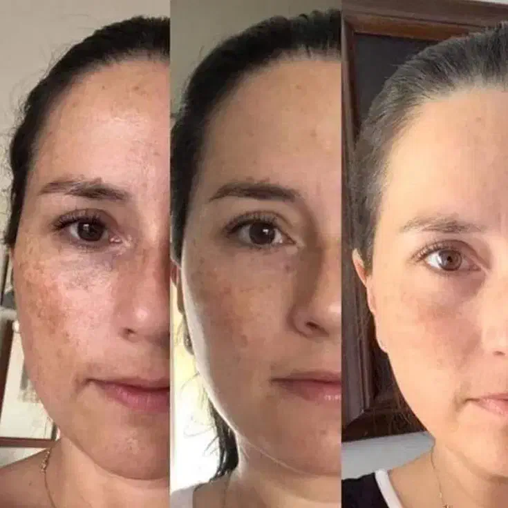 از بین بردن انواع لک صورت|خدمات آرایشگری و زیبایی|فردیس, فردیس|دیوار