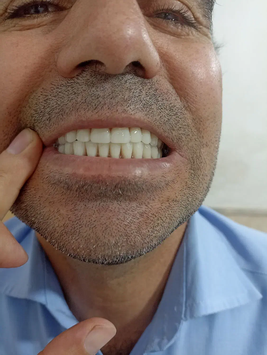 دندانسازی ساخت دندان (مصنوعی) متحرک|خدمات آرایشگری و زیبایی|قم, سید معصوم|دیوار