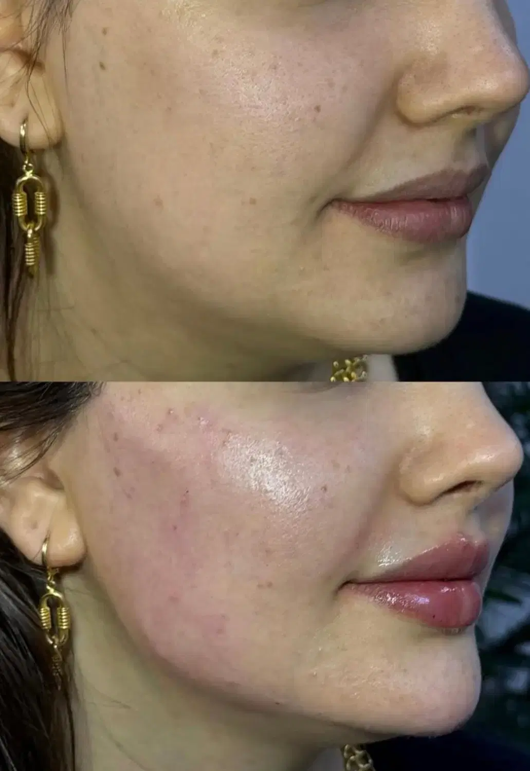 آفر ۹۰ درصدی ژل و بوتاکس و پی آر پی و نخ|خدمات زیبایی و سلامت|تبریز, |دیوار