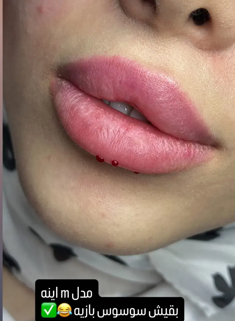 تزریق ژل و بوتاکس و مزو ژل|خدمات آرایشگری و زیبایی|فسا, |دیوار