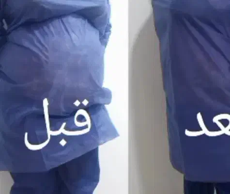 ساکشن چربی ،تزریق چربی ، تزریق ژل ،فیلر لب بلفارو|خدمات آرایشگری و زیبایی|خرم‌آباد, |دیوار