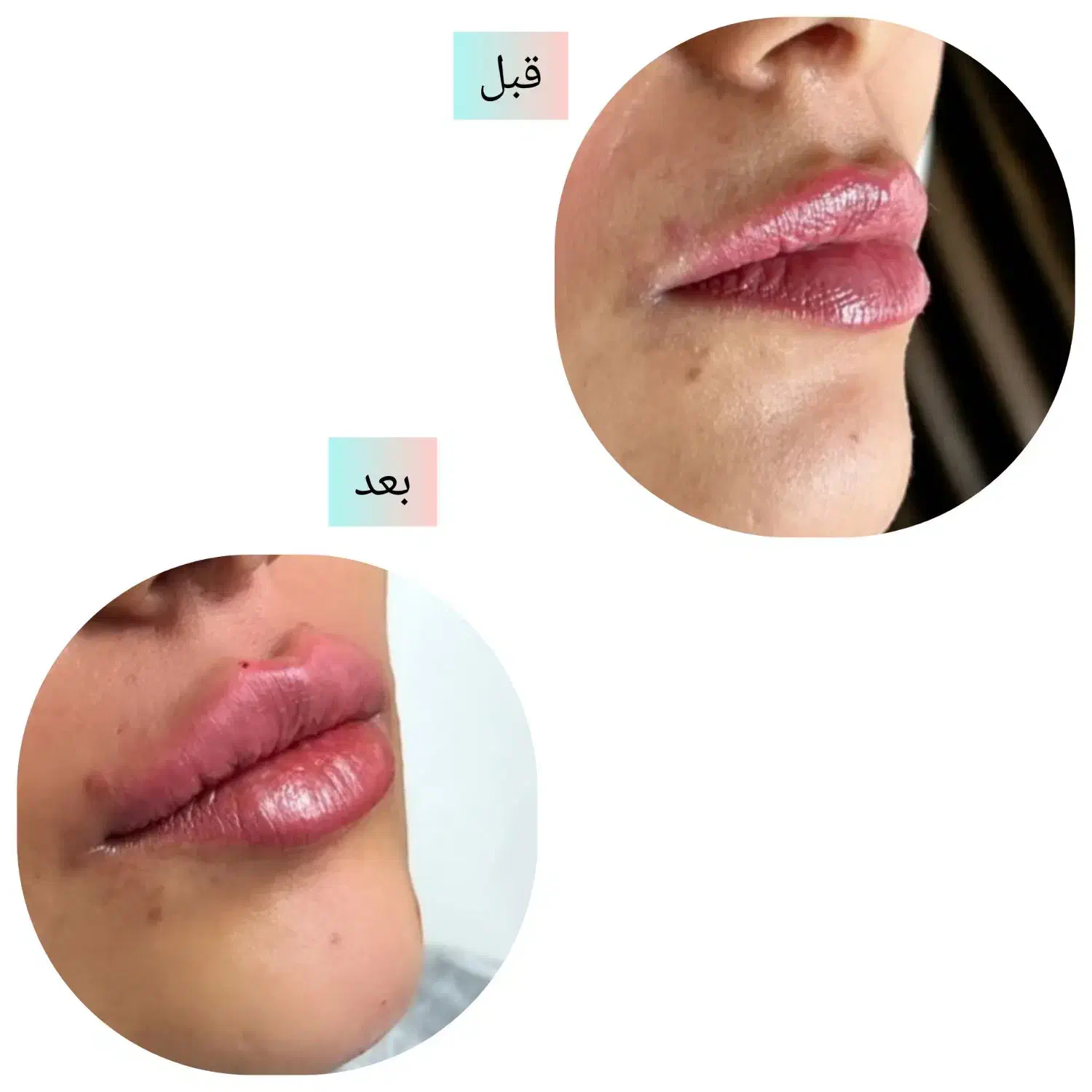 جشنواره تزریق ژل بدون درد و کبودی تضمینی|خدمات آرایشگری و زیبایی|جیرفت, |دیوار