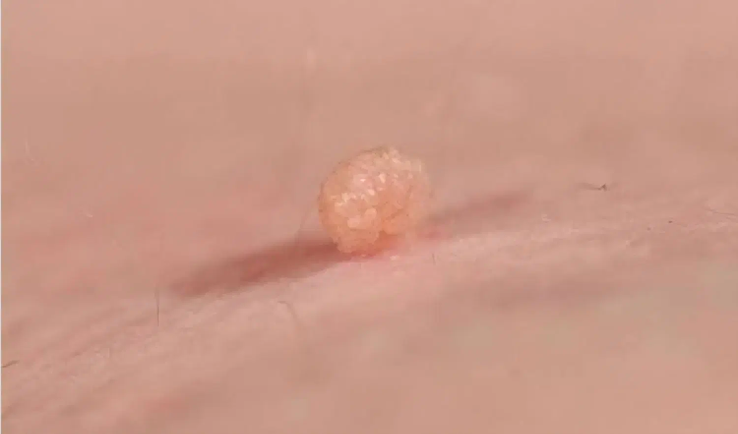 خدمات پلکسر از بین بردن خال وزیگیل|خدمات آرایشگری و زیبایی|پاکدشت, پاکدشت (مامازند)|دیوار