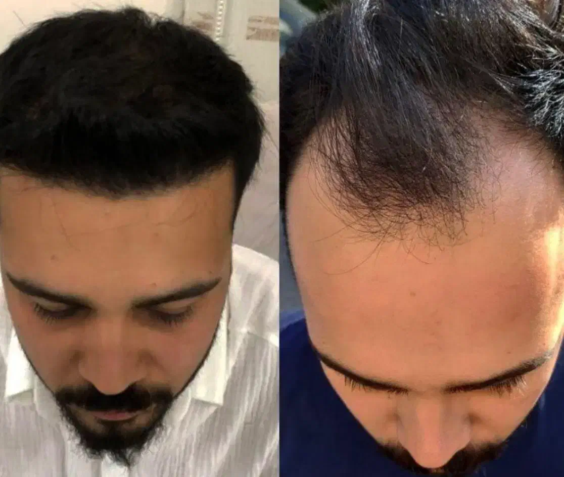 کاشت مو و ابرو تخصصی|خدمات آرایشگری و زیبایی|رشت, گلسار|دیوار