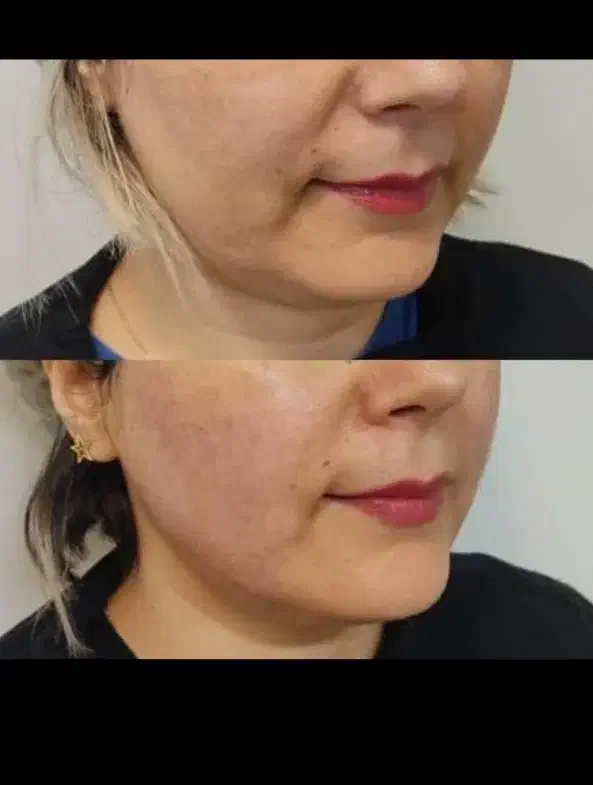 جشنواره درمان کک ومک/لک/خال/ریزش مودریک جلسه|خدمات آرایشگری و زیبایی|اصفهان, طامه|دیوار