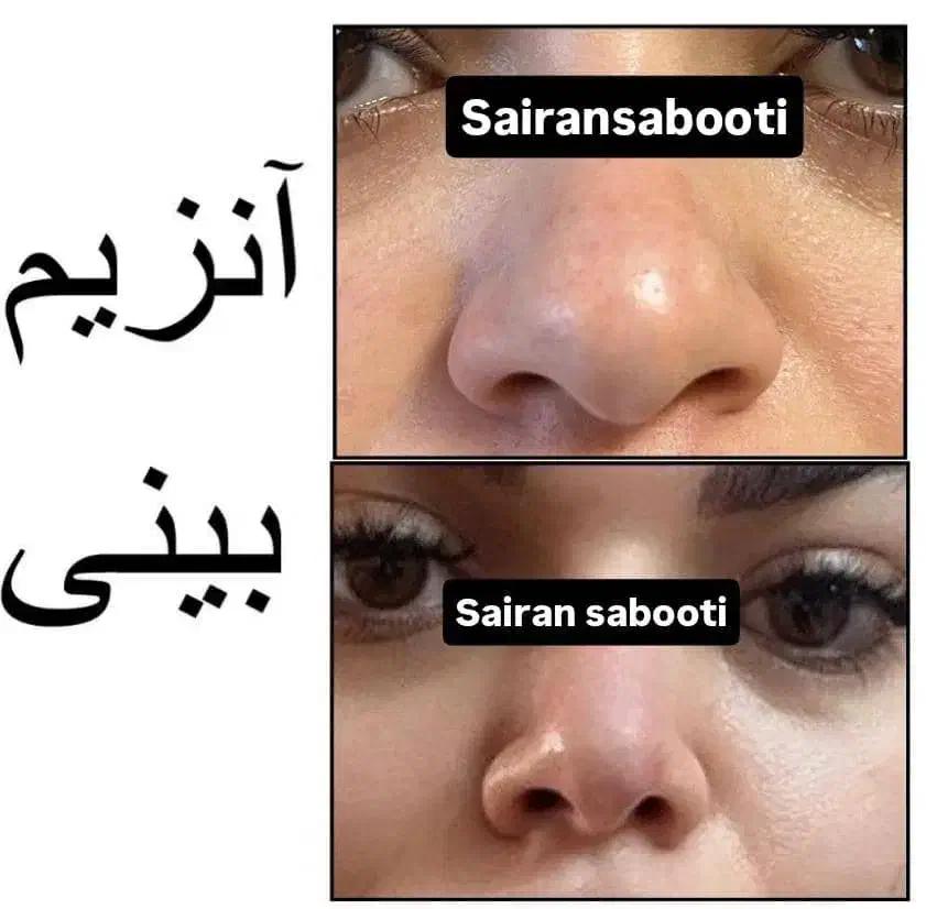 آنزیم بینی گوشتی غبغب پلاسما تراپی،مزونیدلینگ|خدمات آرایشگری و زیبایی|شیراز, محراب|دیوار