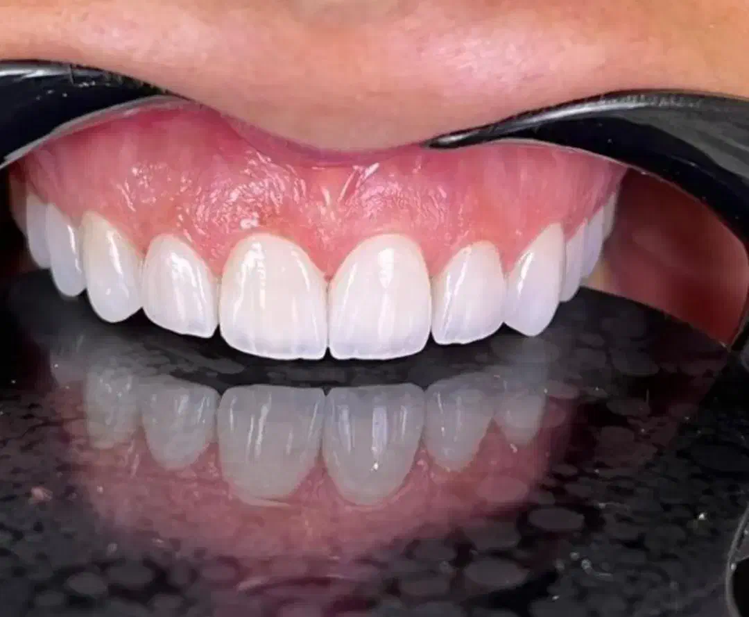 خدمات زیبایی کامپوزیت لمینیت بلیچینگ|خدمات آرایشگری و زیبایی|قم, زنبیل آباد|دیوار