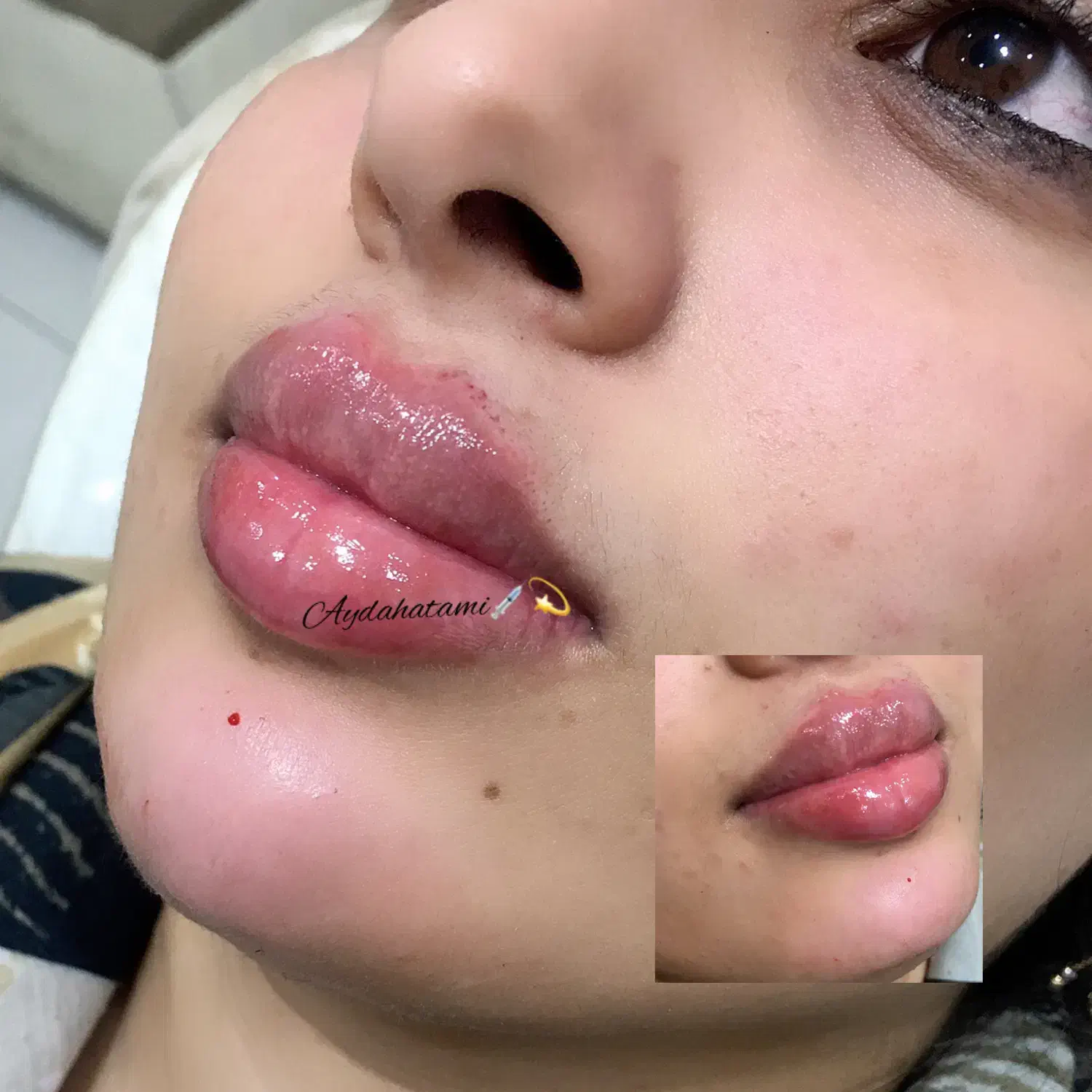تزریق ژل و بوتاکس توسط پیرا پزشک مجرب|خدمات آرایشگری و زیبایی|اهواز, پادادشهر|دیوار