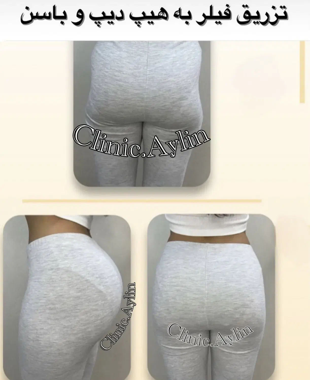 تزریق ژل لب فیلر بوتاکس لیفت فیلربادی کانتورینگ|خدمات آرایشگری و زیبایی|تهران, مرزداران|دیوار