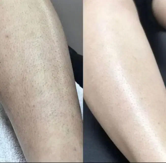 جدیدترین دستگاه لیزر 2025 در شهر جم|خدمات آرایشگری و زیبایی|جم, |دیوار