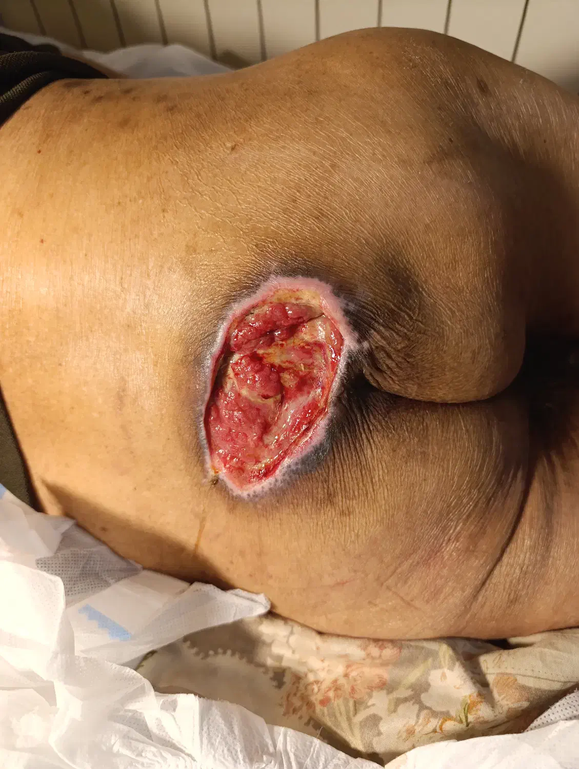 درمان نوین انواع زخم دیابتیک و بستر و جراحی و بخیه|خدمات آرایشگری و زیبایی|صومعهسرا, |دیوار