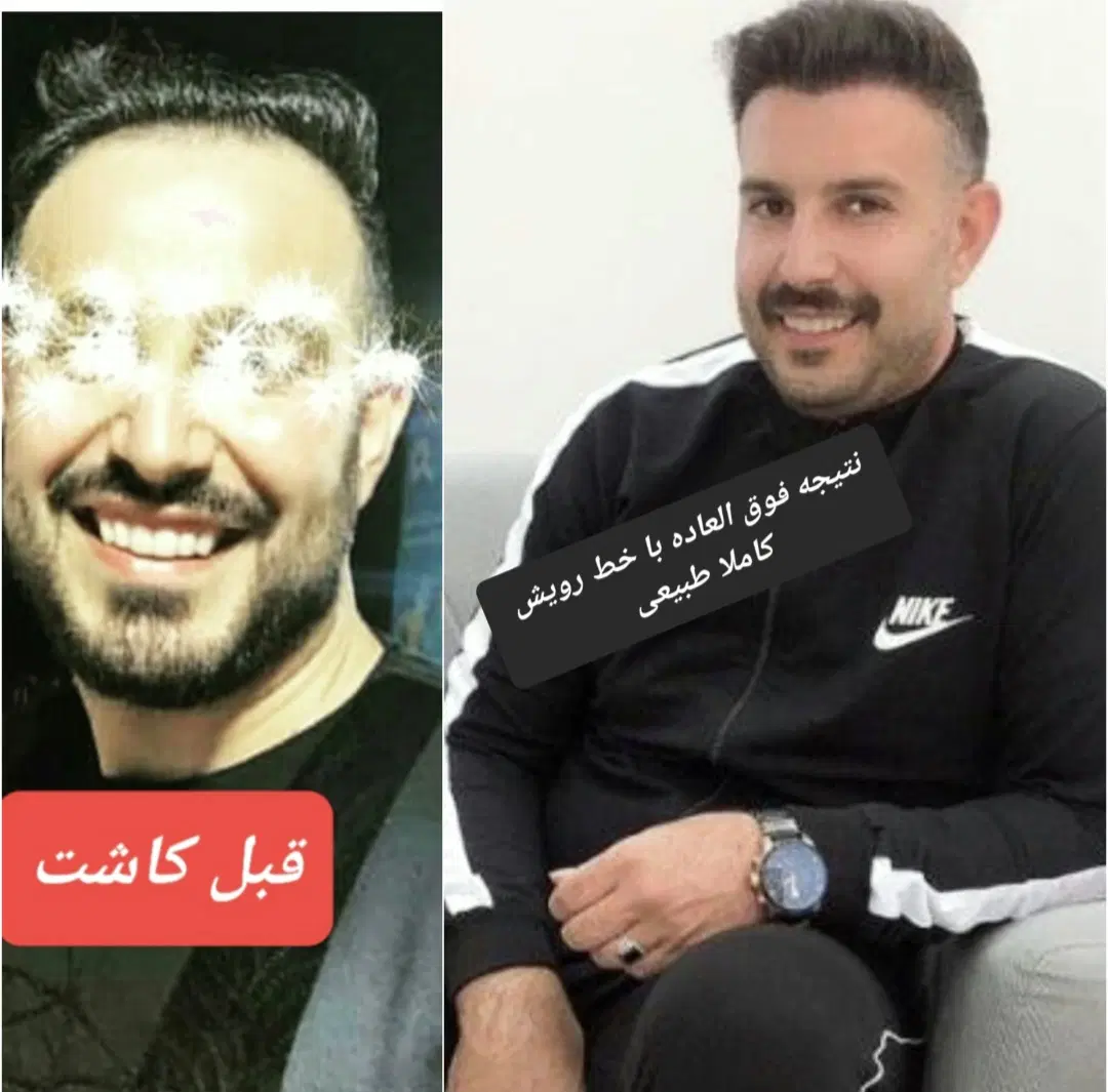 کاشت مو|خدمات آرایشگری و زیبایی|اهواز, کیانپارس |دیوار