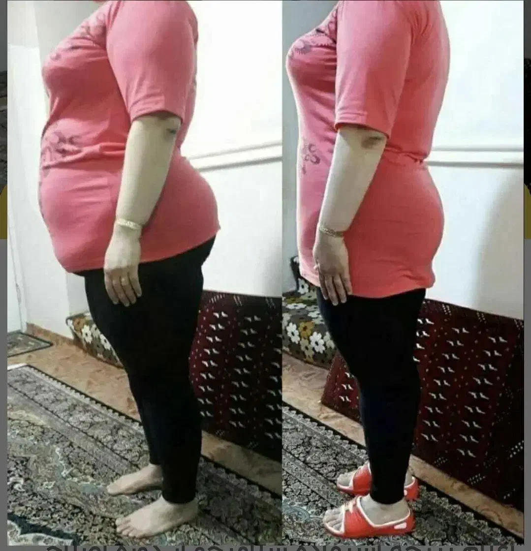 لاغری سریع|آرایشی، بهداشتی، درمانی|رشت, دباغیان|دیوار