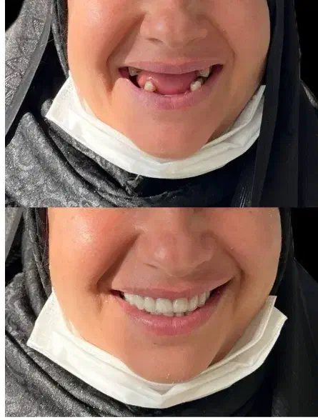 دندانسازی/دندان مصنوعی/ لمینتی / ضمانتی و چکی|خدمات آرایشگری و زیبایی|مشهد, عبادی|دیوار