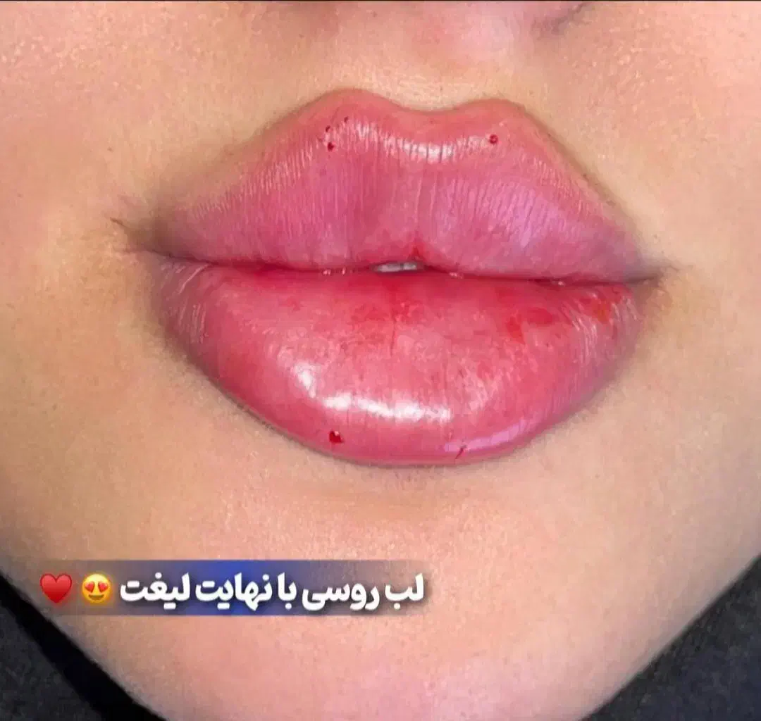 تزریق ژل و بوتاکس|آرایشگاه و سالن‌های زیبایی|ری, دولت‌آباد|دیوار