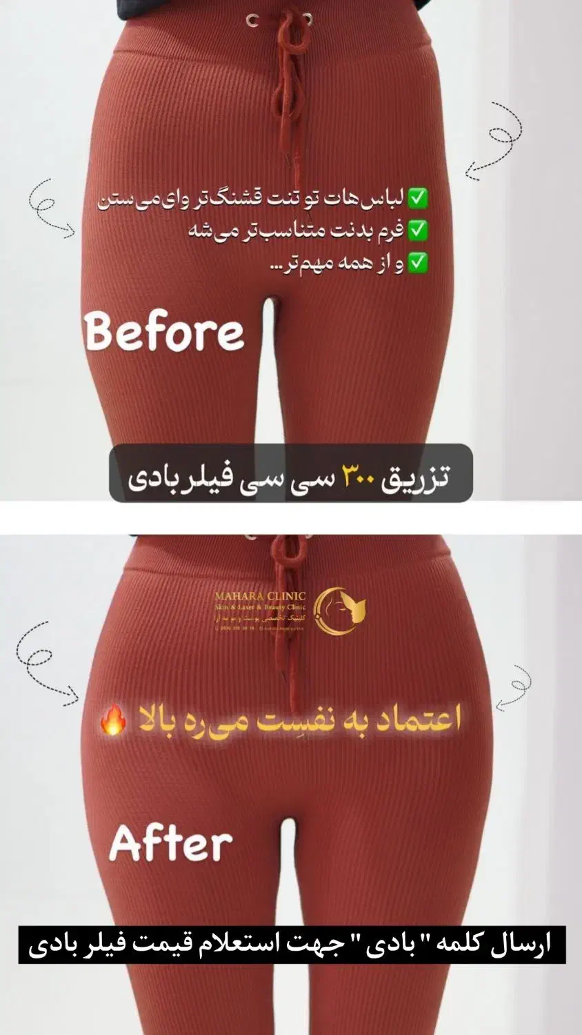 آف۵۰٪ فیلر بادی باسن سینه بیکینی دست پا شکم DRزنان|خدمات آرایشگری و زیبایی|مشهد, هفت تیر (آب و برق)|دیوار