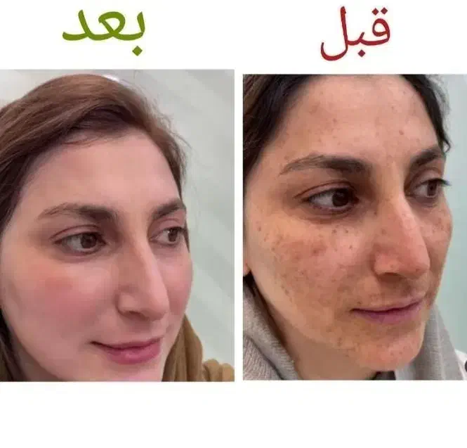 جشنواره درمان تضمینی کک و مک/ زگیل / فقط در 1 جلسه|خدمات آرایشگری و زیبایی|اصفهان, باتون|دیوار