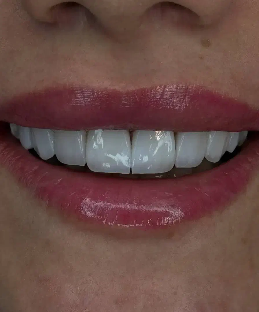 کامپوزیت.لمینت|خدمات آرایشگری و زیبایی|تهران, هفت حوض|دیوار