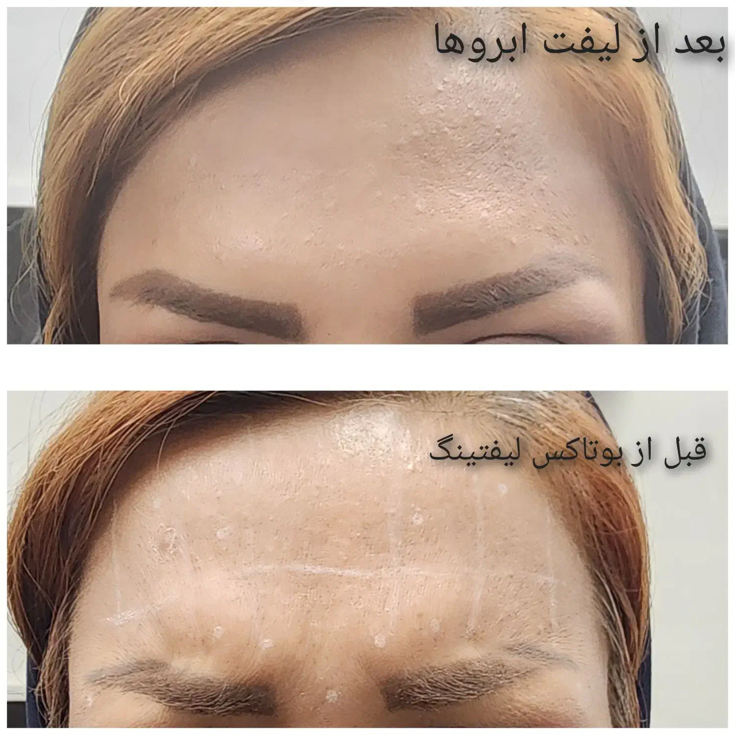 تزریق بوتاکس تخصصی توسط پزشک در گلدسته|خدمات آرایشگری و زیبایی|چهاردانگه (تهران), |دیوار