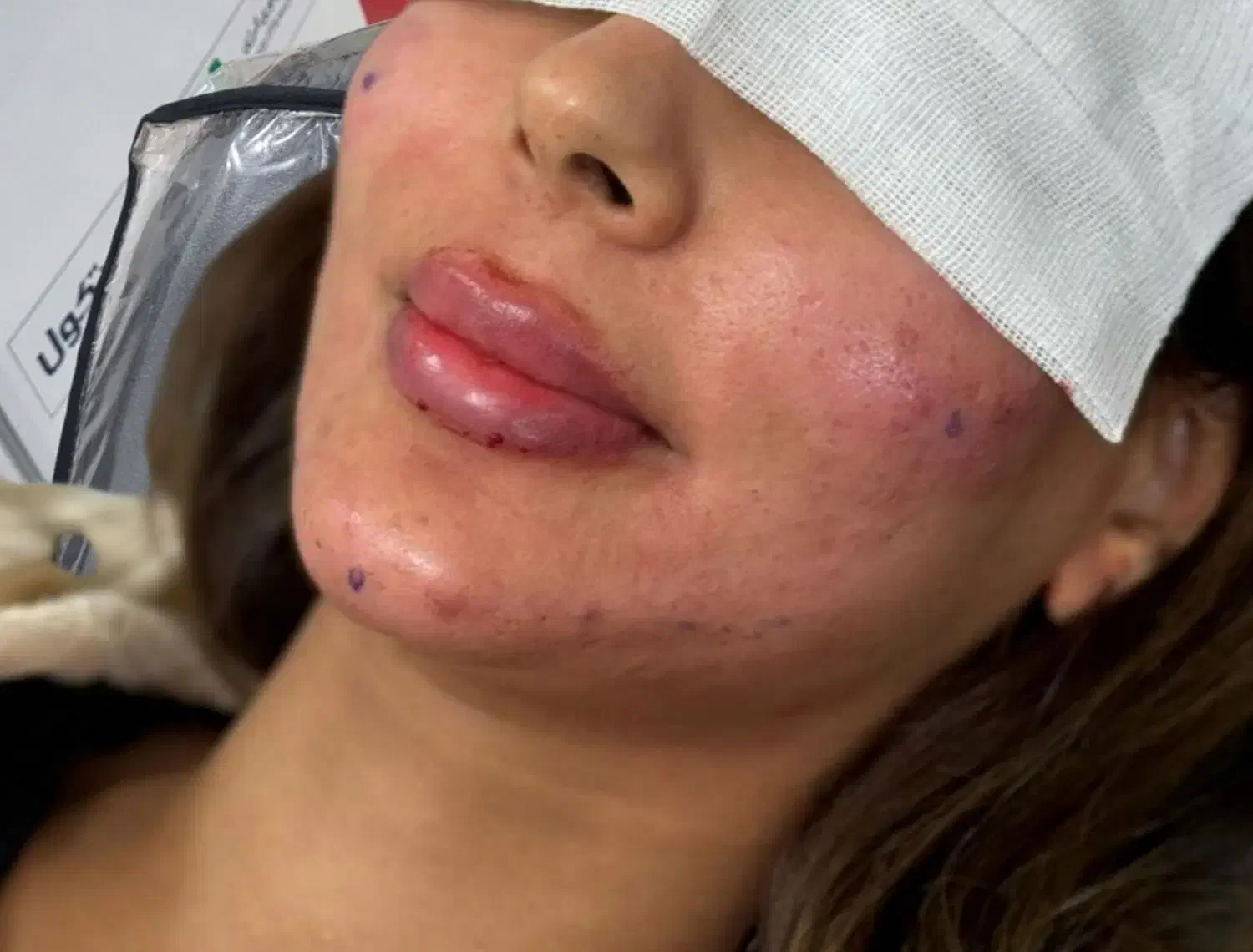 ژل بوتاکس خالبرداری|خدمات آرایشگری و زیبایی|زابل, |دیوار