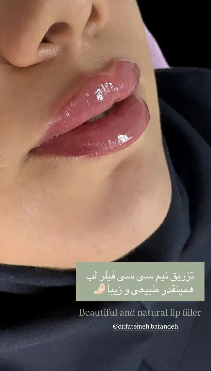 تخصص در بوتاکس و فیلر و جوانسازی|خدمات آرایشگری و زیبایی|شیراز, بعثت|دیوار