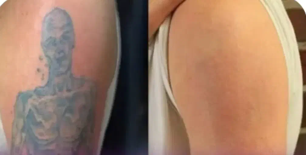 پاک کردن تاتو با پیشرفته ترین لیزر حال حاضر دنیا|خدمات آرایشگری و زیبایی|کرمانشاه, |دیوار