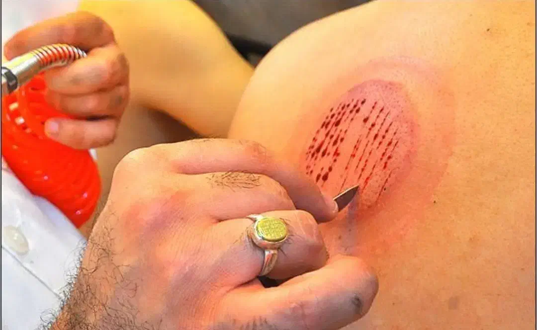 درمان درد سیاتیک و دیسک کمر|آرایشی، بهداشتی، درمانی|هامون, |دیوار