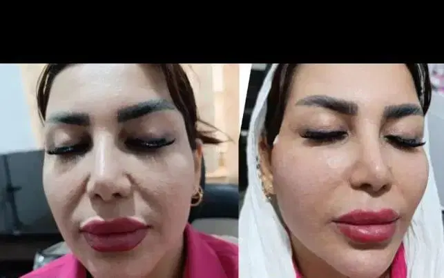 پکیج اقتصادی اندولیفت هایفوکندلا ۳۶بعدی دکترداریوش|خدمات زیبایی و سلامت|مشهد, فلسطین|دیوار