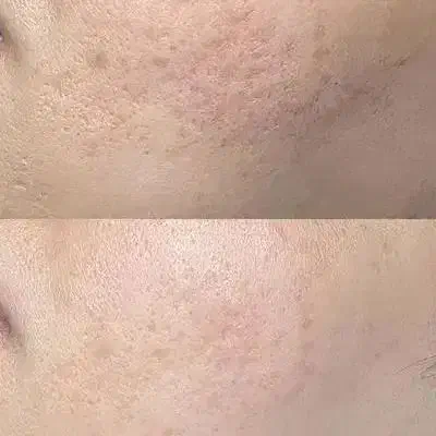 پاکسازی و جوانسازی پوست با تجهیزات پیشرفته|خدمات آرایشگری و زیبایی|رشت, گلسار|دیوار