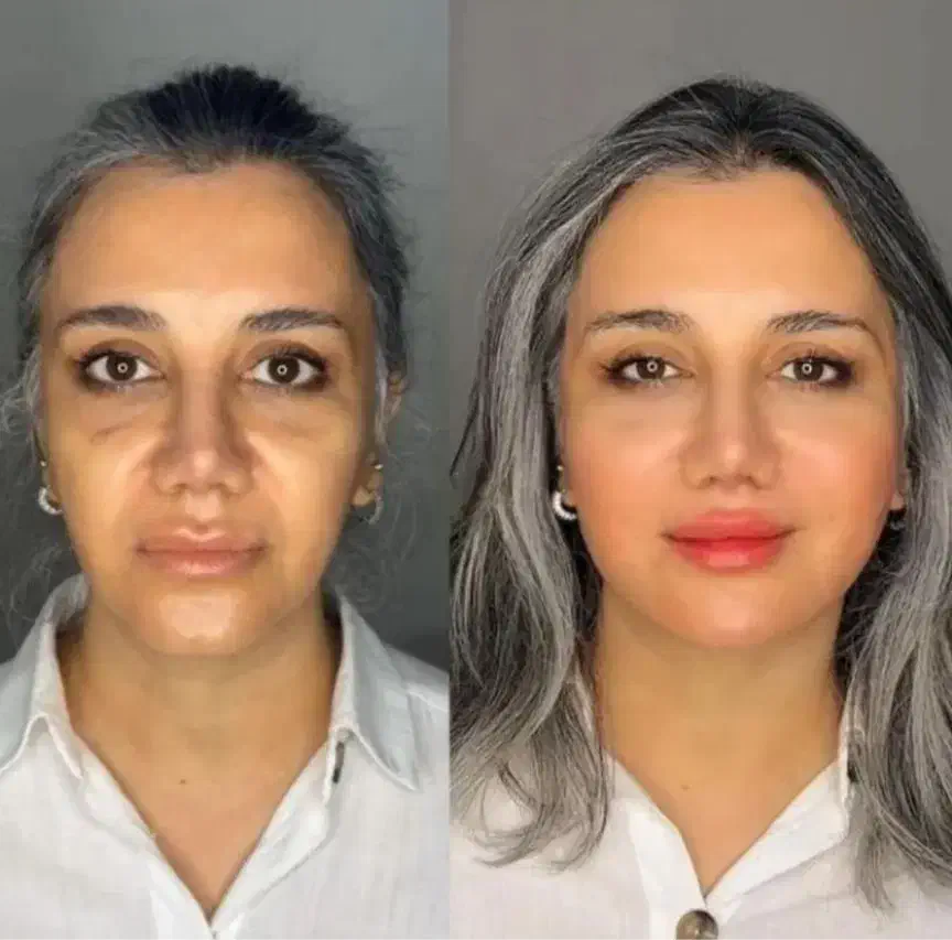 تزریق فیلر،ژل،بوتاکس|خدمات آرایشگری و زیبایی|کرمانشاه, |دیوار