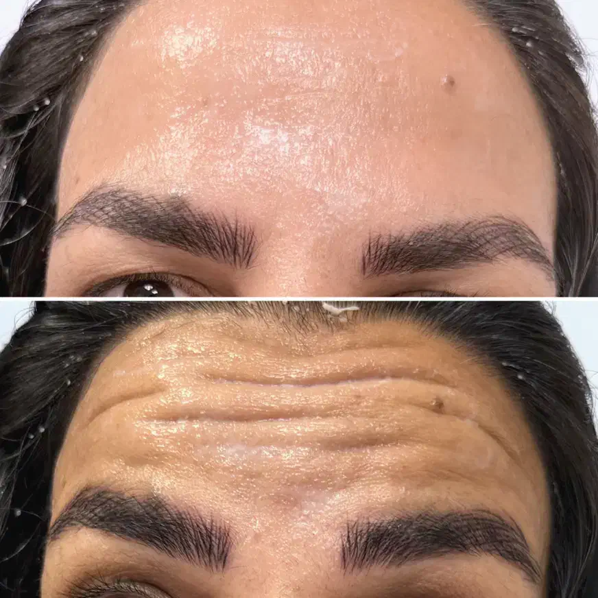 لیزر بوتاکس پی ارپی توسط دکتر|خدمات آرایشگری و زیبایی|مشهد, وکیلآباد|دیوار