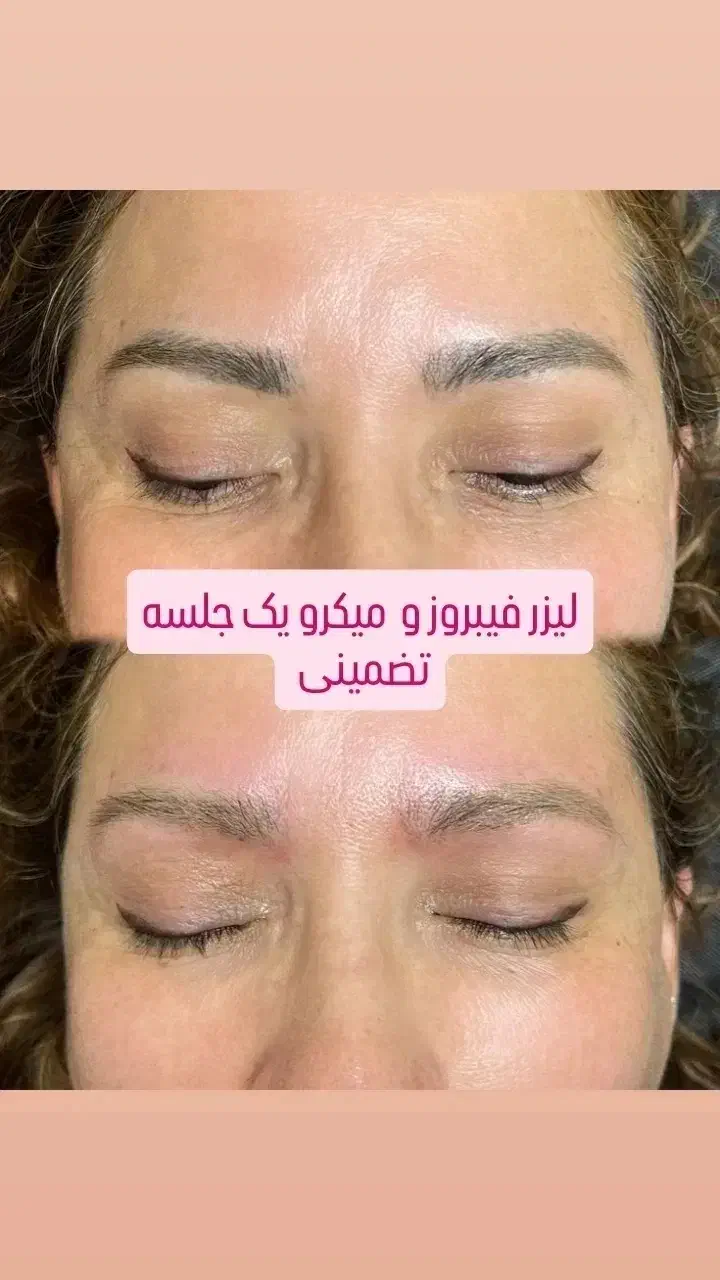 ابرو/لیزر پوست /شیدینگ/لیزر مو سفید/درمان کبد چرب|خدمات آرایشگری و زیبایی|خرم‌آباد, |دیوار