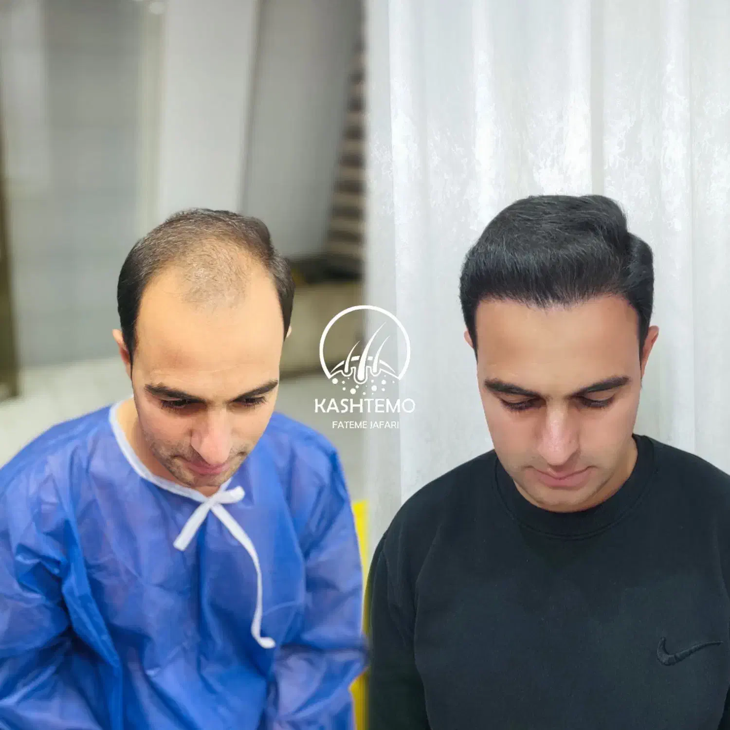 برترین کاشت شقیقه در شیراز|خدمات آرایشگری و زیبایی|شیراز, قصرالدشت|دیوار