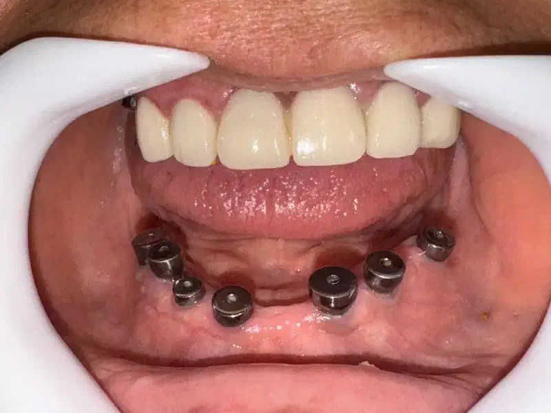 ایمپلنت دیجیتال اقساطی بدون سود در انواع برندها|خدمات آرایشگری و زیبایی|شیراز, زرگری|دیوار