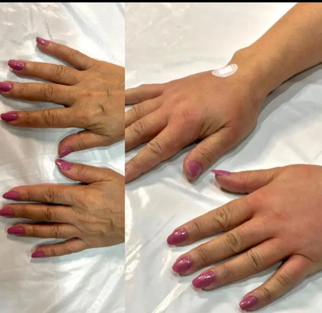 ژل و بوتاکس و مزو ژل|خدمات آرایشگری و زیبایی|بومهن, |دیوار