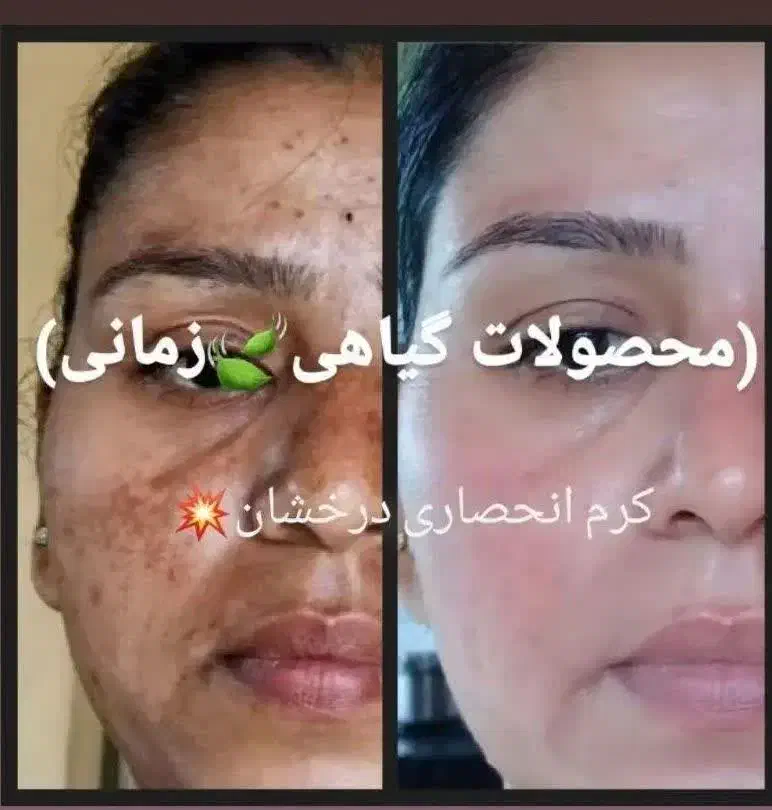 کرم انحصاری درخشان بدون بازگشت|آرایشی، بهداشتی، درمانی|رشت, منظریه|دیوار