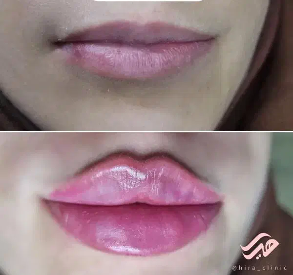 فیلرلب روسی ،گونه و زاویه،بوتاکس، فول فیس،زیرچشم|خدمات آرایشگری و زیبایی|شیراز, ستارخان|دیوار