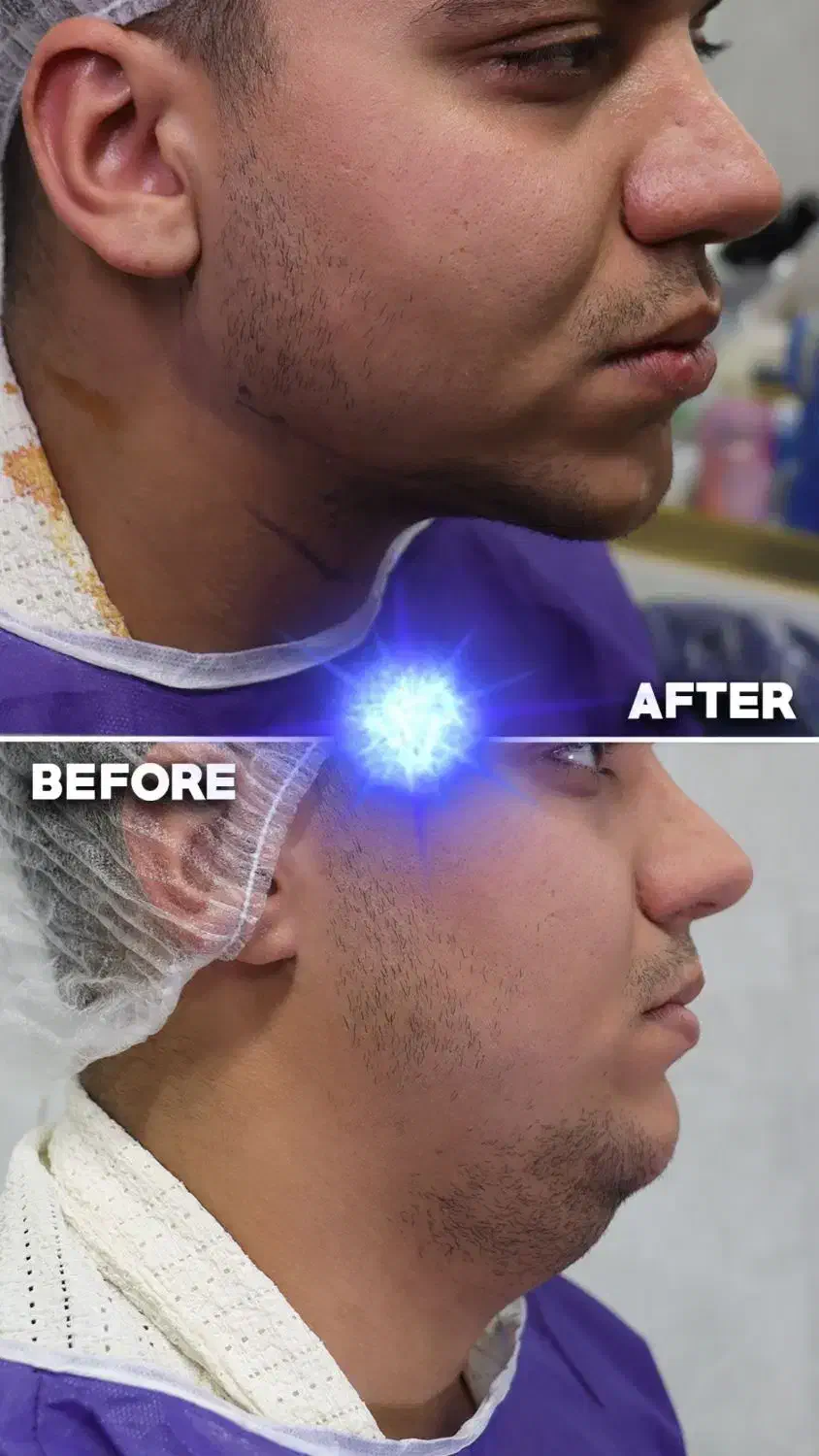 جشنواره ساکشن شکم ، پهلو و غبعب|خدمات آرایشگری و زیبایی|کرمانشاه, |دیوار