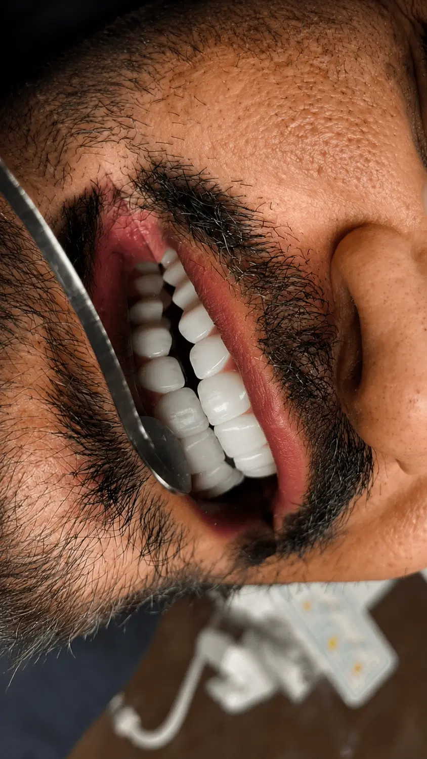 کامپوزیت لمینیت درمان دندان|خدمات زیبایی و سلامت|تهران, دریا|دیوار