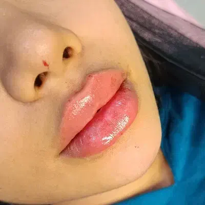 تزریقات زیبایی|خدمات آرایشگری و زیبایی|قرچک, مهدیه|دیوار