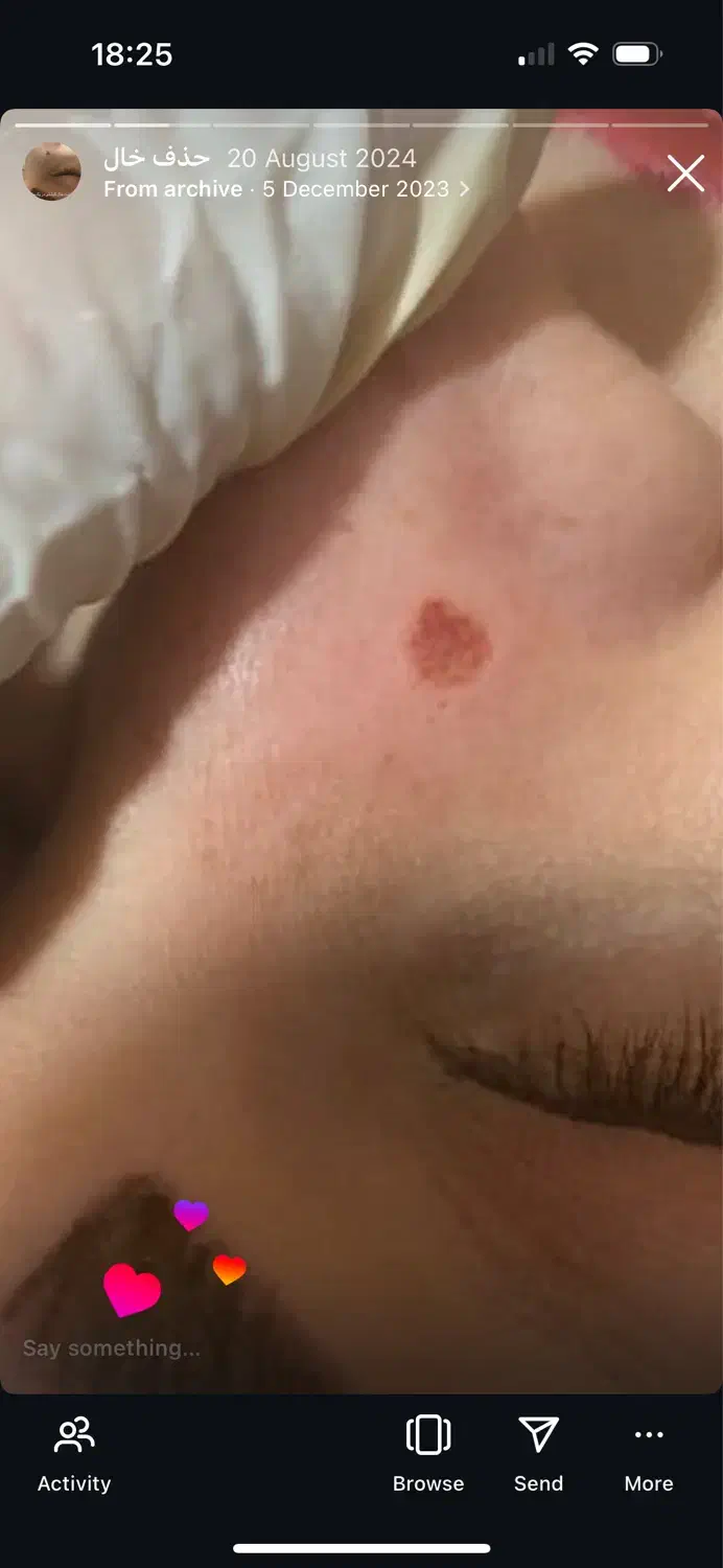 پاکسازی پوست دائمی|خدمات آرایشگری و زیبایی|قرچک, میرزائی جنوبی|دیوار