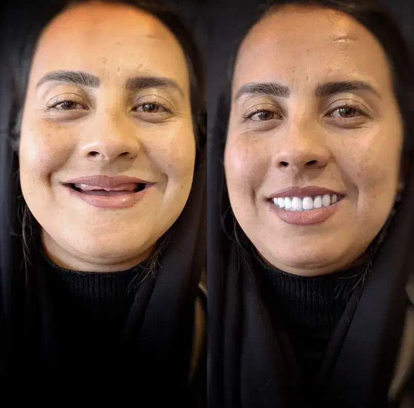 دندانسازی مصنوعی دندان مصنوعی با کیفیت و زیبا|خدمات آرایشگری و زیبایی|تبریز, |دیوار