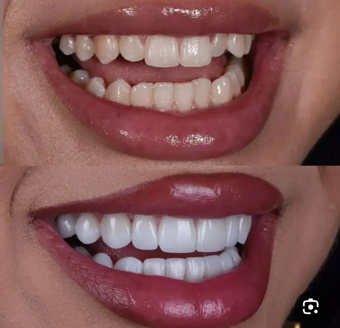 جشنواره کامپوزیت دندان فقط واحدی 700|خدمات آرایشگری و زیبایی|فولادشهر, B4|دیوار