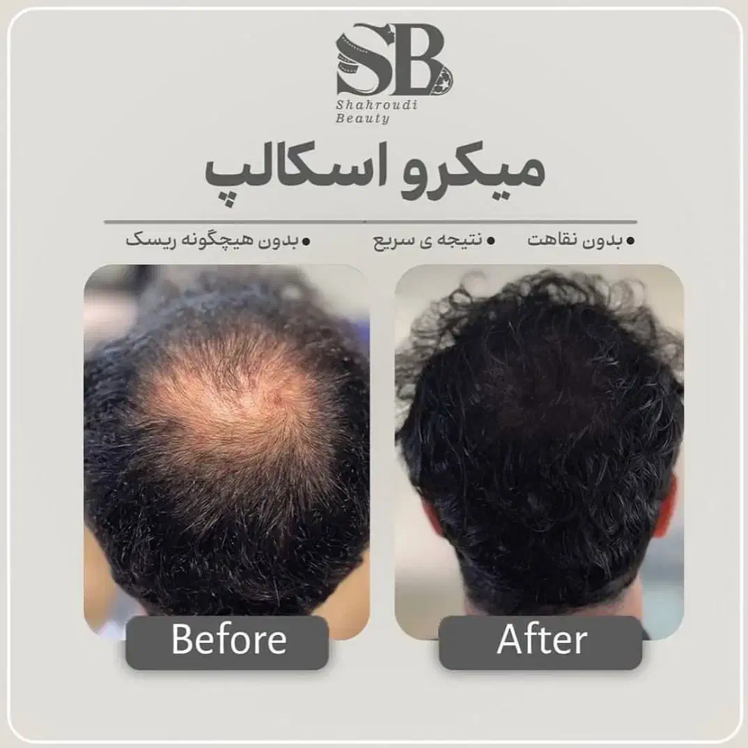 میکرو اسکالپ مکمل کاشت مو|خدمات آرایشگری و زیبایی|یاسوج, |دیوار