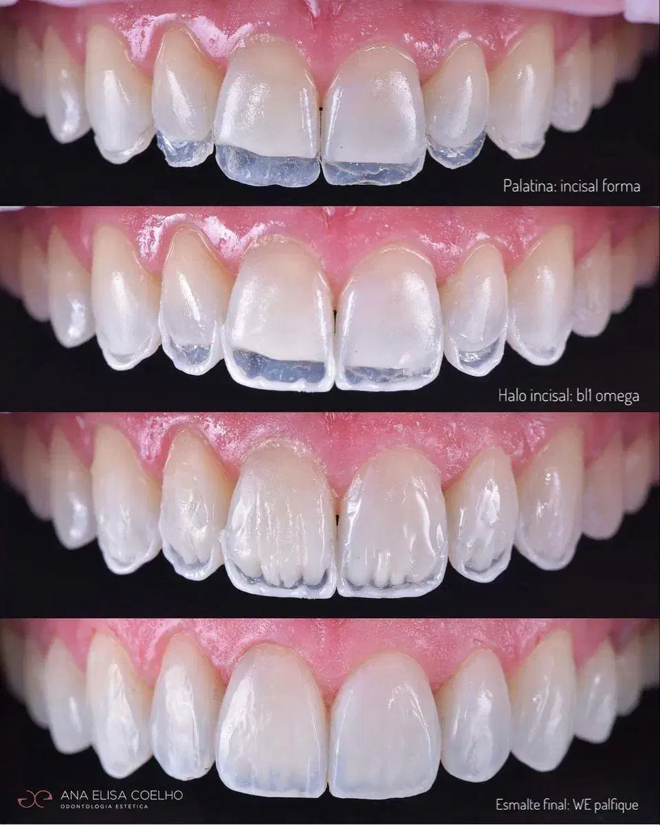 لمینیت لب شیشه قسطی کامپوزیت بلیچینگ دندان|خدمات آرایشگری و زیبایی|مشهد, سجاد شهر|دیوار